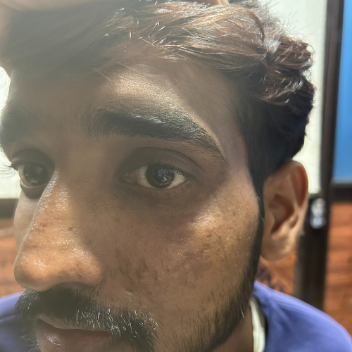 Acne Scar Improvement