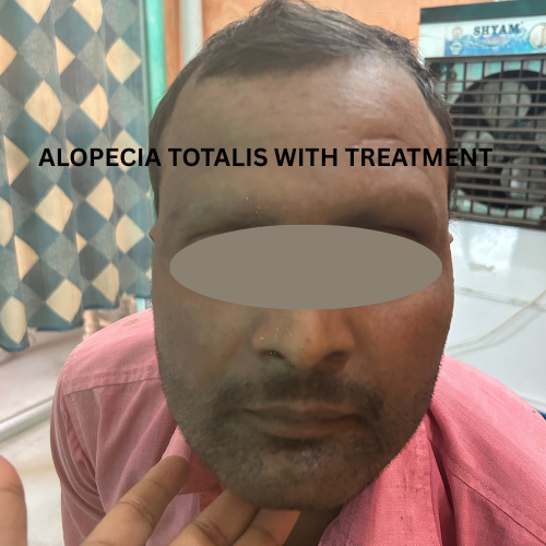 Alopecia Totalis Treatment Result