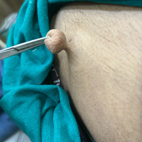 Skin Tag Removal Procedure