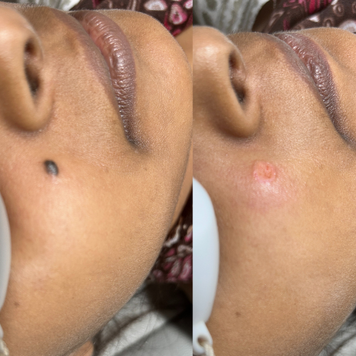 Facial Lesion Treatment Result