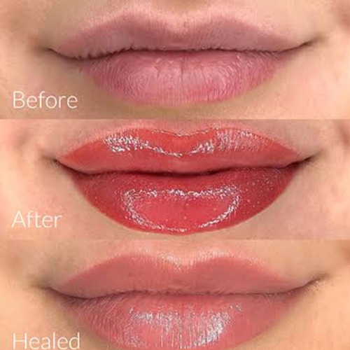 Lip Pigmentation Aesthetic Result