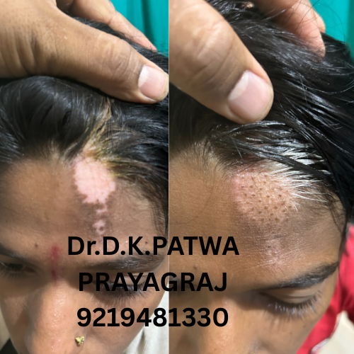 Scalp Vitiligo Treatment Result